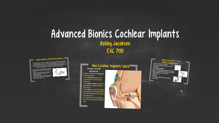 Advanced Bionics Cochlear Implants By Ashley Jacobsen 1092