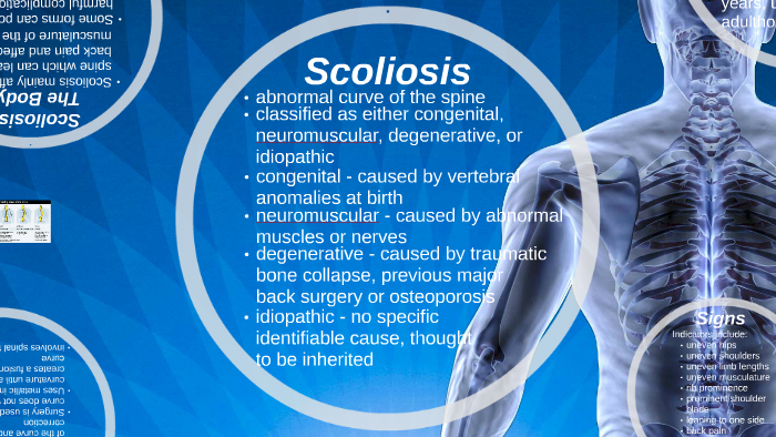 Scoliosis by Sarah Nunnink