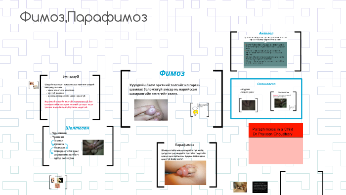 Фимоз,Парафимоз by bold bymbal on Prezi