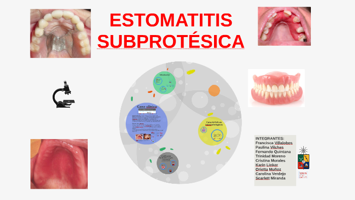 Que Es La Estomatitis Subprotesica Que Es La Estomatitis Subprotesica
