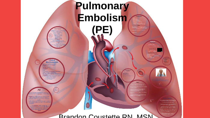 Pulmonary Embolism for new grad RN by Brandon Coustette on Prezi