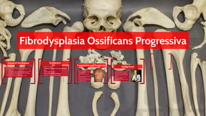 Fibrodysplasia Ossificans Progressiva by Ethan Brokelschen on Prezi