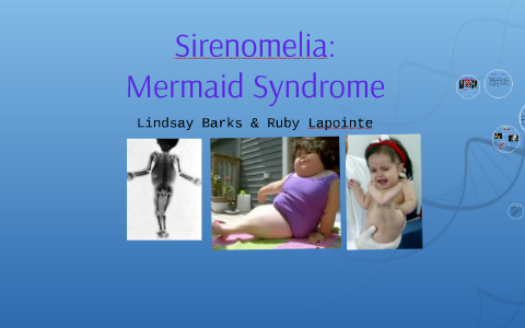 mermaid syndrome survivors