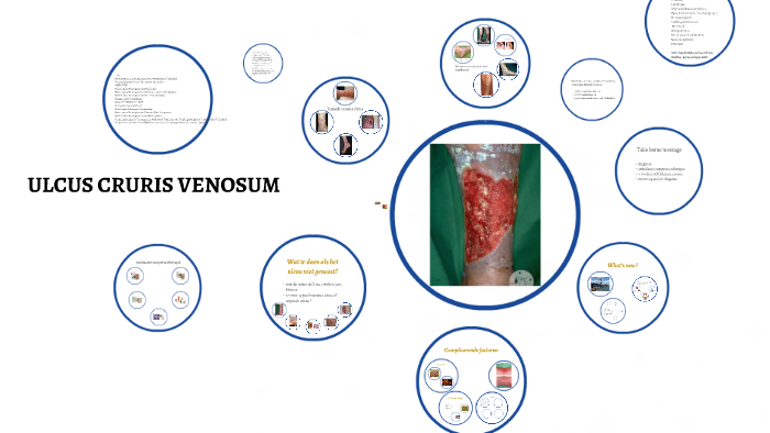 ULCUS CRURIS VENOSUM By Ineke Bruynzeel On Prezi