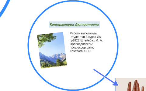 Контрактура дюпюитрена презентация