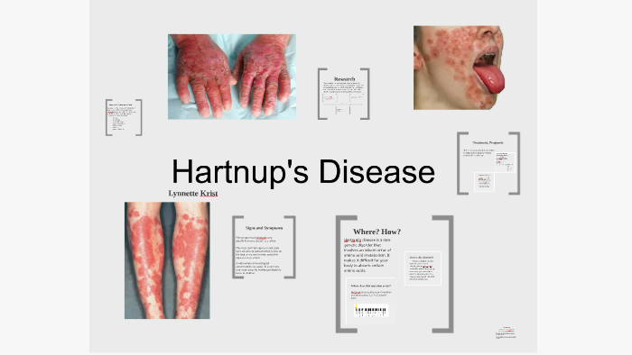 Hartnups Disease Prezi by Lynnette Krist on Prezi Next