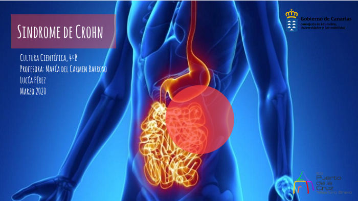 Sindrome de Crohn by Lucía Pérez Rodríguez on Prezi