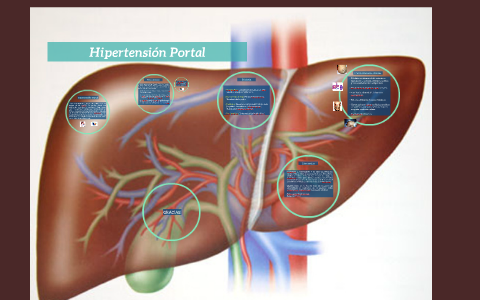 Hipertensión Portal by Ligia Chia on Prezi