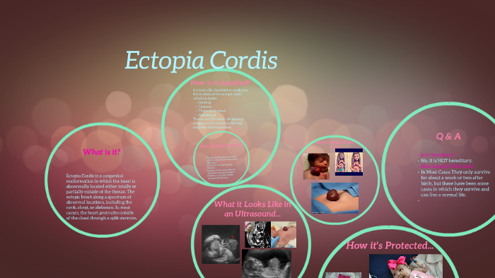 Ectopia Cordis by Mattie Jackson on Prezi