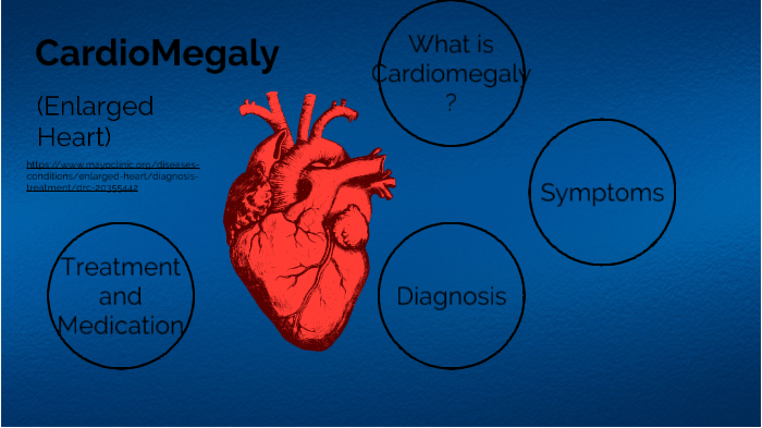 Enlarged Heart (Cardiomegaly): What It Is, Symptoms & Treatment