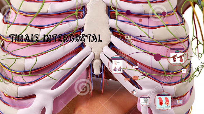 Tiraje Intercostal By Karla Chicaz On Prezi tiraje-intercostal-by-karla-chicaz-on-prezi
