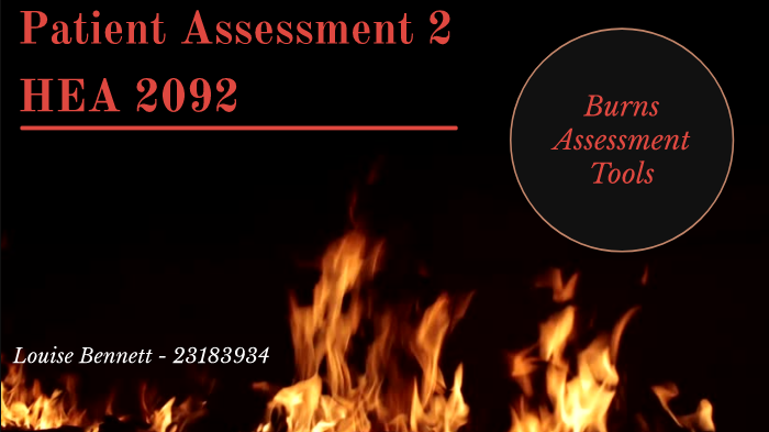 Burns Assessment Tools By Louise Bennett On Prezi 8142