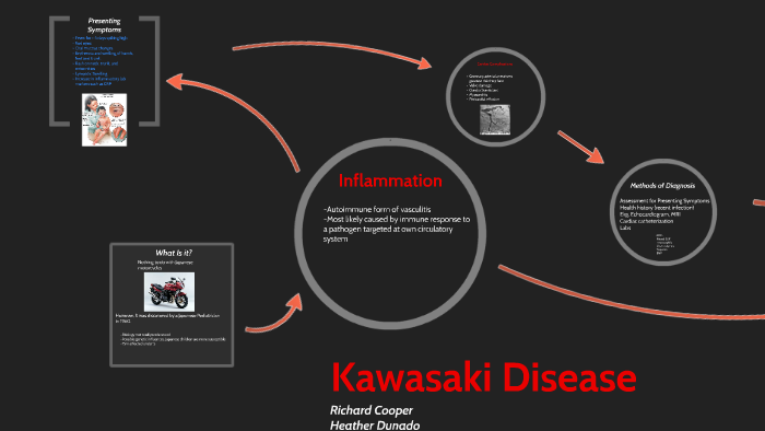 case study kawasaki disease