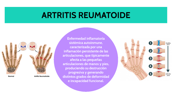 Artritis reumatoide by Jean Carlos Jiménez Osorio on Prezi