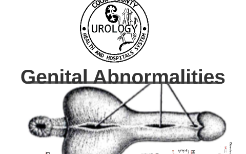 Genital Abnormalities by Cook County Urology on Prezi