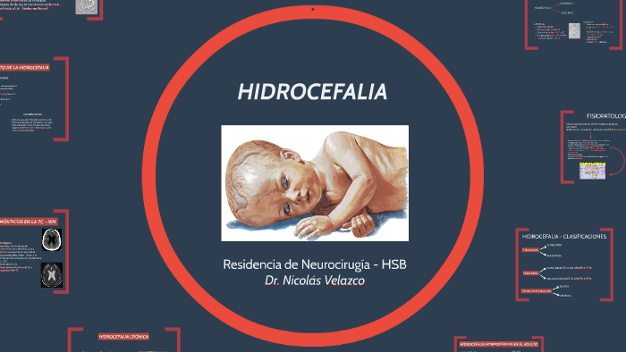 Hidrocefalia By Nicolás Velazco On Prezi 6159