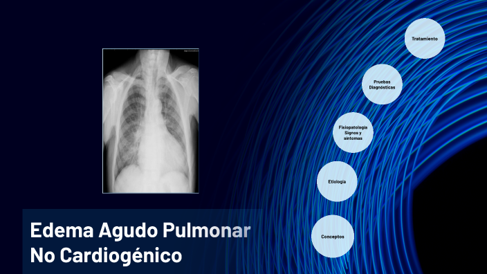 Edema Agudo Pulmonar No Cardiogénico By Karla Daniela Sánchez García On ...