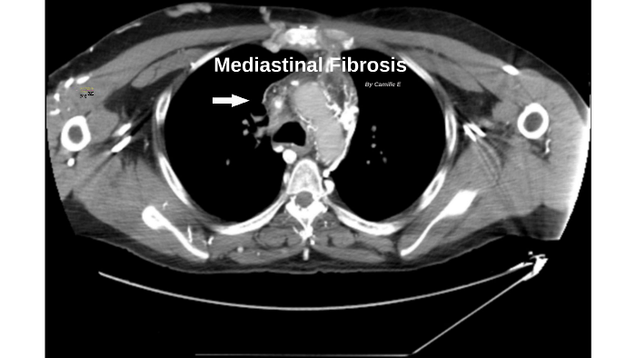 Mediastinal Fibrosis by Camille Eastvold on Prezi