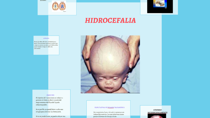 Hidrocefalia By Carlos Diaz On Prezi Next 7276