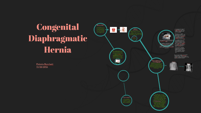 Congenital Diaphragmatic Hernia By Dakota Burchett