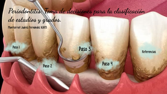 Periodontitis: árbol Clínico De Toma De Decisiones Para La ...