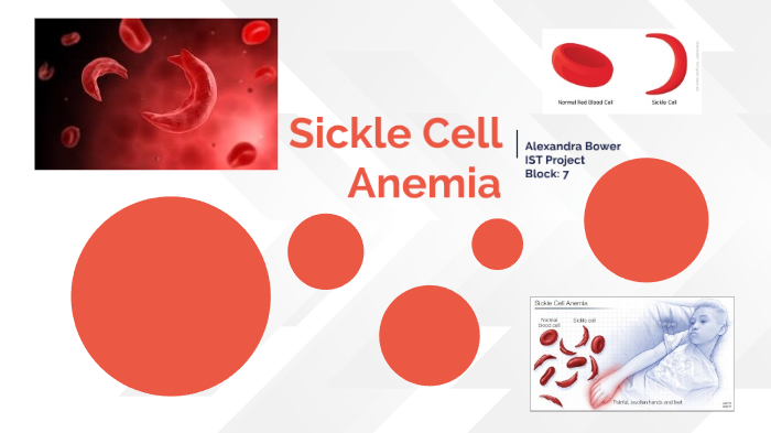 Sickle Cell Anemia Biology Project By Alexandra Bower On Prezi