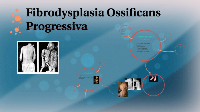 Fibrodysplasia Ossificans Progressiva by Annabel Norman on Prezi