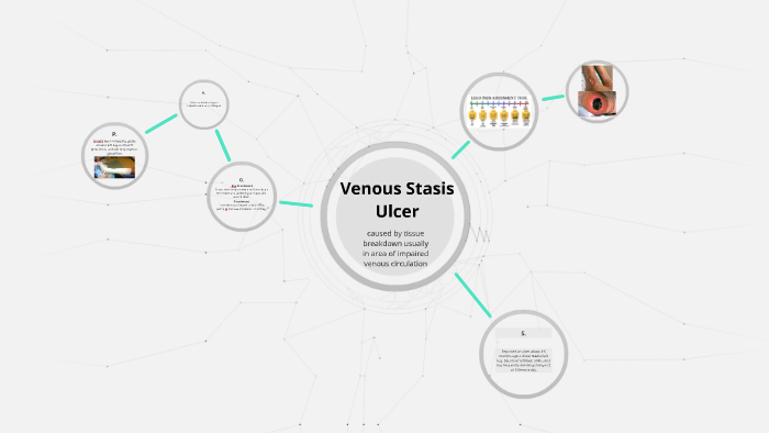 Venous Stasis Ulcer by Nicole Encarnacion on Prezi
