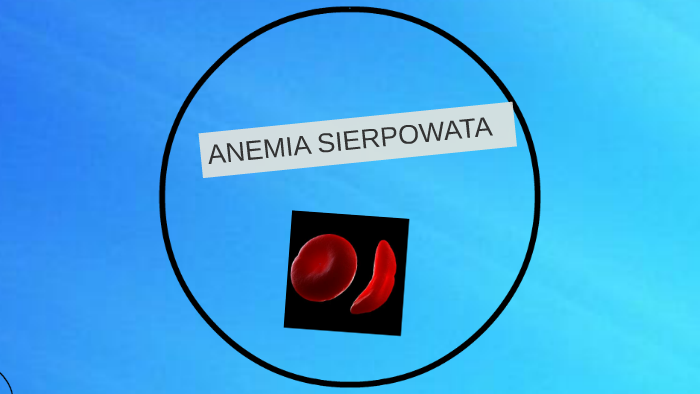 Anemia Sierpowata By Klaudia ławińśka 3768