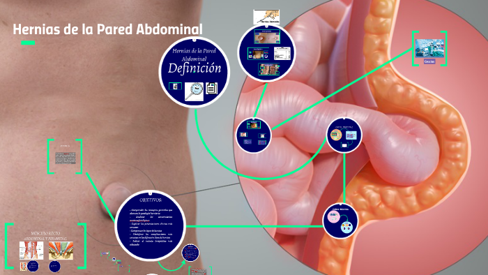 Hernias de la Pared Abdominal by Fausto Pérez on Prezi