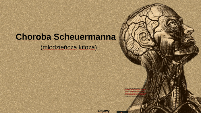 Choroba Scheuermanna by Kamil Black on Prezi