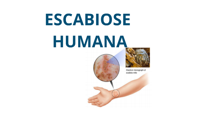 Escabiose Humana By Sanclair Solon De Medeiros