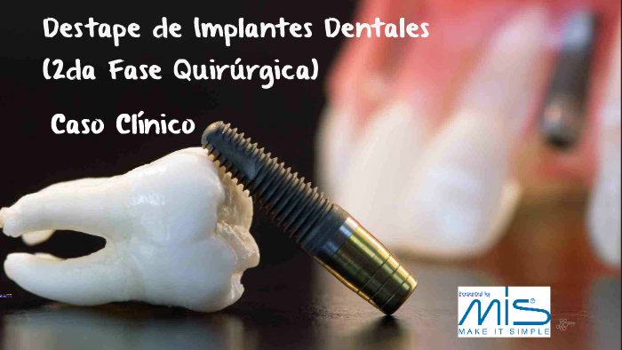 Destape De Implantes Dentales By Sebastian Riballo On Prezi 6315