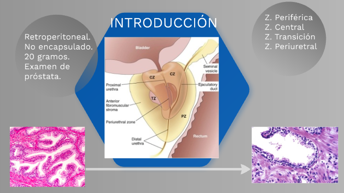 cancer de prostata scielo