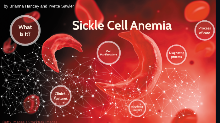 oral path: sickle cell anemia by Brianna Hancey on Prezi