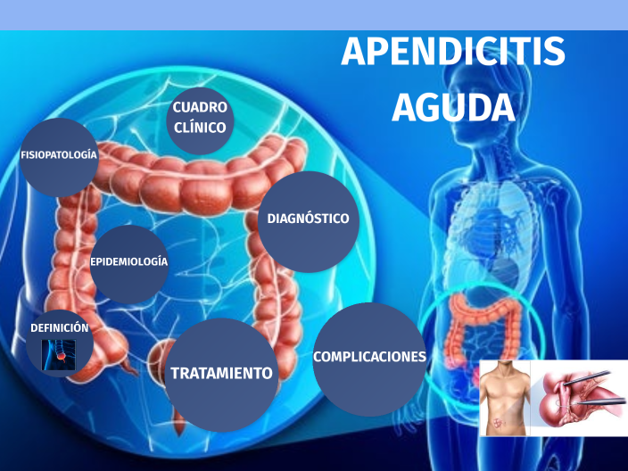 APENDICITIS AGUDA by Alejandro Cadiz on Prezi