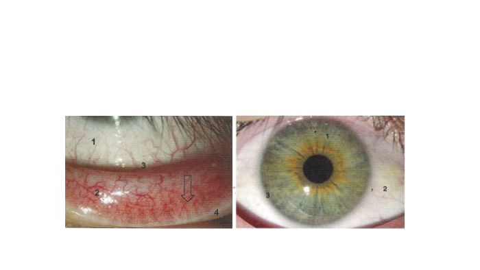 Sindrome de Foville superior by Paola Marquez Barron on Prezi