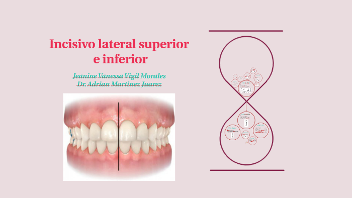 incisivo lateral