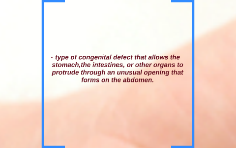 Abdominal Wall Defects by Amal Al-Marri on Prezi