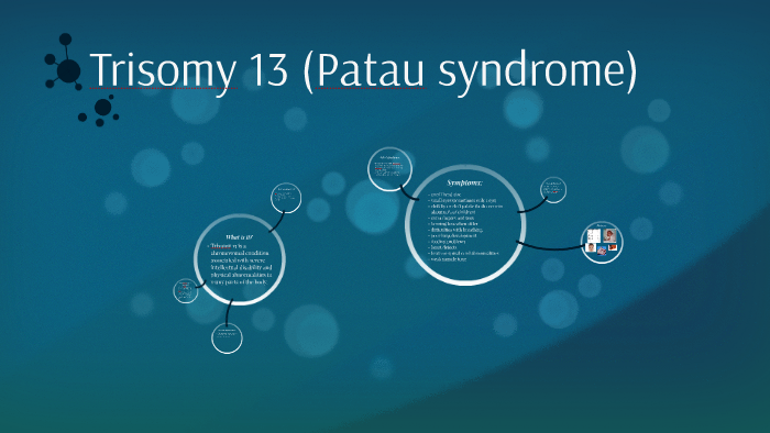 Patau Syndrome Trisomy 13 By Stephanie S