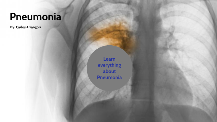 Pneumia by Carlos Arrangoiz Talamante