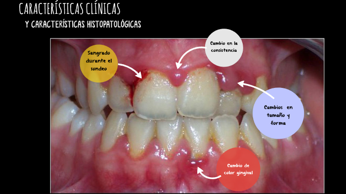 gingivitis by Diana Galán on Prezi