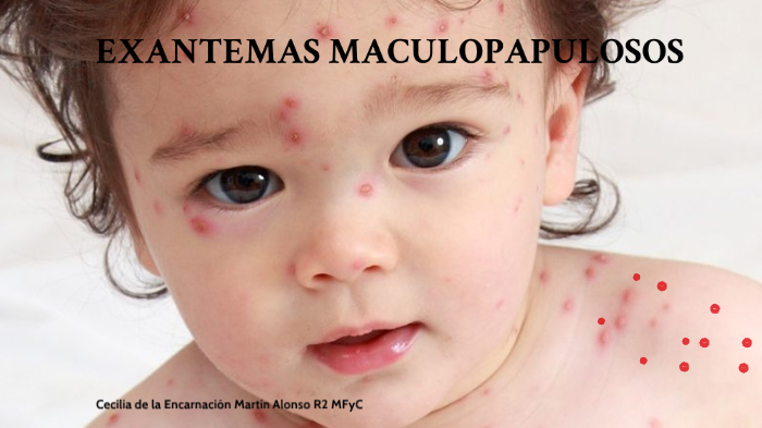 Exantemas maculopapulosos by Cecilia de la E. Martín Alonso on Prezi