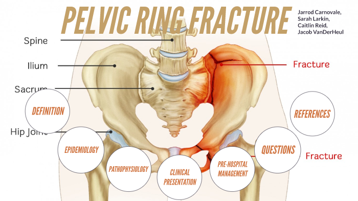 PARA107 Pelvic Ring Fracture by Caitlin Reid on Prezi