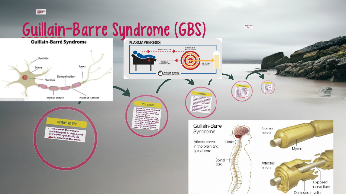 Guillain Barre Syndrome By Kristofer Ulrich