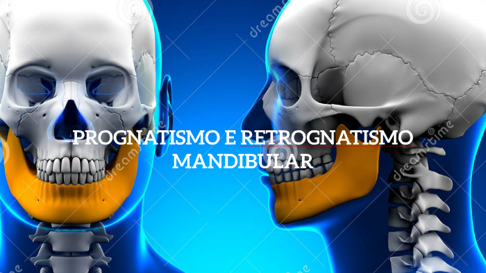 RECUO MAXILO-MANDIBULAR - CLINICA DA FACE