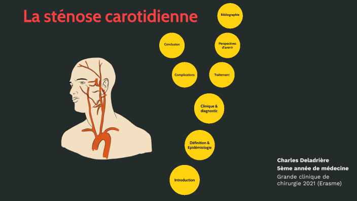 La sténose carotidienne by Charles Deladrière