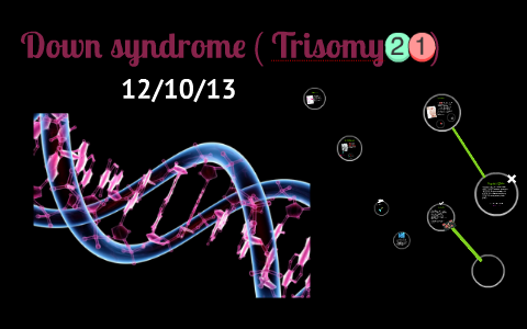 Down Syndrome ( Trisomy 21) By