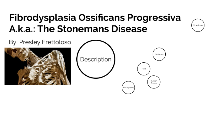 Fibrodysplasia ossificans progressiva by presley frettoloso on Prezi
