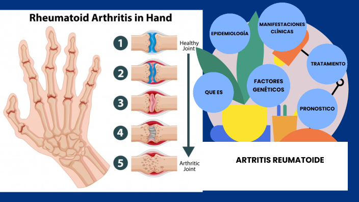 ARTRITIS REUMATOIDE by lolita lara on Prezi